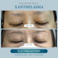 Xanthelasma Treatment Malaysia