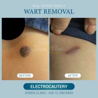 Wart Removal in Subang Jaya