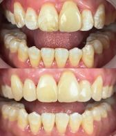 Iconic Smiles: Transform Your Teeth with Icon Treatment