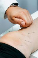 Acupuncture Therapy Acupuncture Therapy